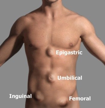 Hernia anatomy illustration