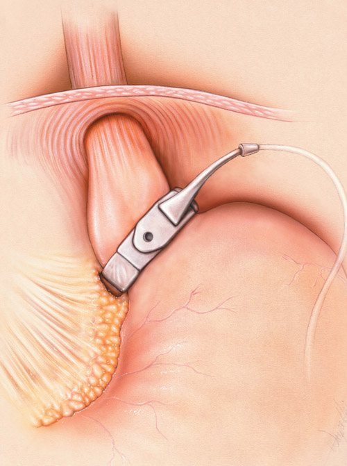 Minimally invasive surgical procedure illustration